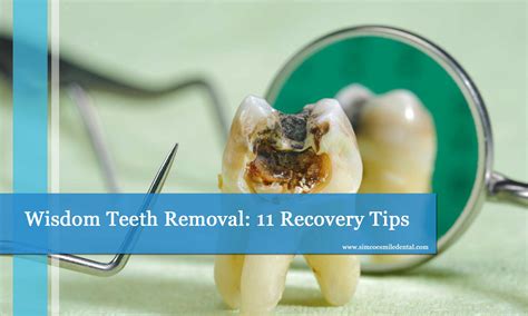 What To Do After Wisdom Teeth Removal